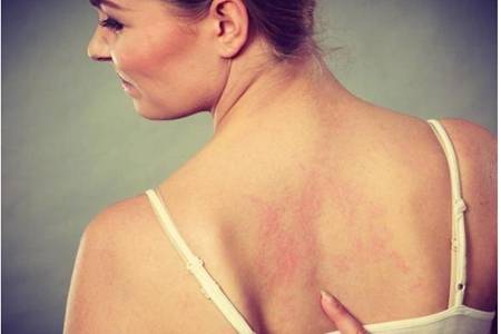 荨麻疹怎样引起的