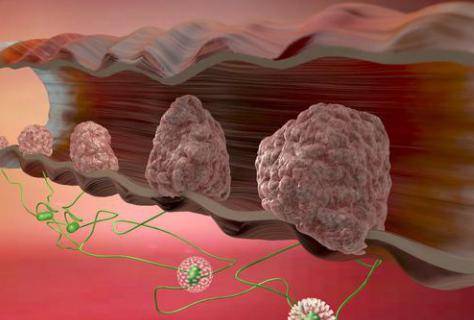直肠癌早期症状