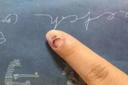 最轻微的灰指甲图片