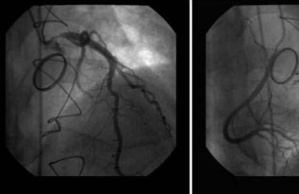 心肌梗死的症状