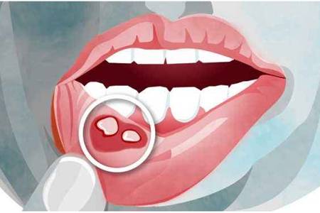 口腔溃疡