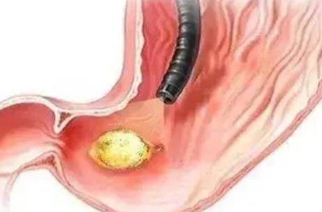 胃癌的早期症状