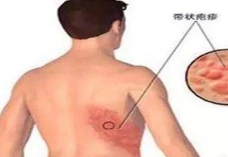 带状疱疹是怎么引起的