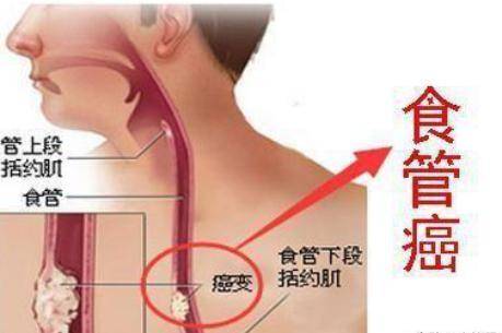 食管癌早期症状